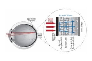 Diagram of an eye receiving photoacoustic retinal stimulation via an epiretinal implant. Red arrows represent a laser pulse hitting the implant, which generates blue acoustic waves depicted as wavy lines that stimulate the underlying retinal cells.